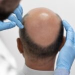 Which is the Best Hair Transplant Clinic in Hyderabad? What You Should Know Before Choosing a Clinic?